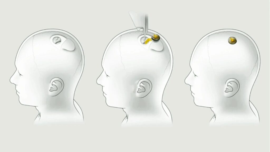 Neuralink implant